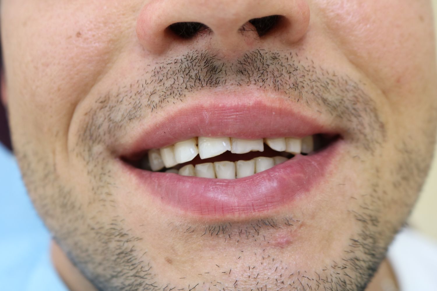 Фото ротовой полости с обломанными передними зубами
